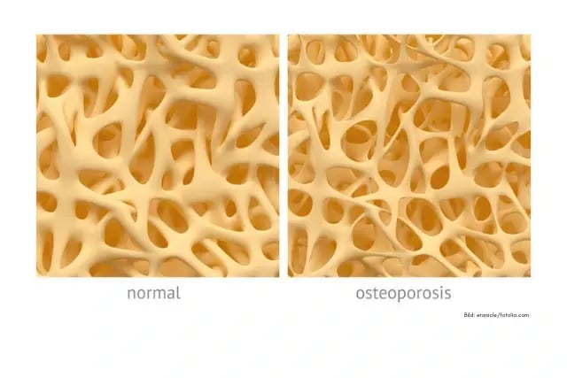 Blog_Beitrag_Osteoporose_640x427px